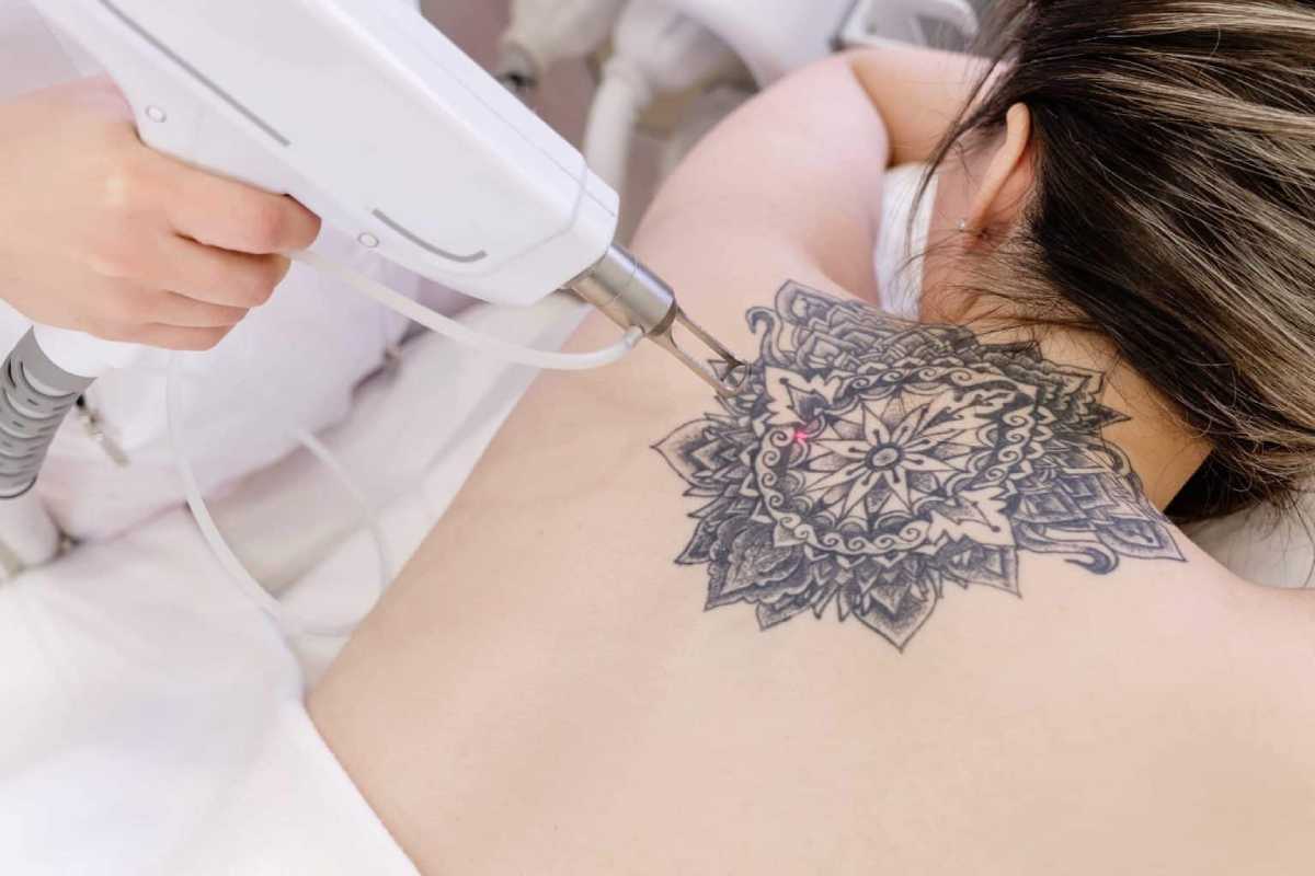 Scar-Free Tattoo Removal