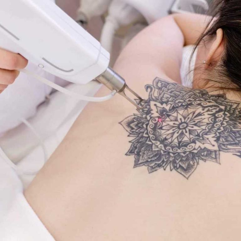 Scar-Free Tattoo Removal